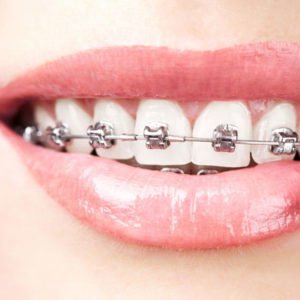 braces