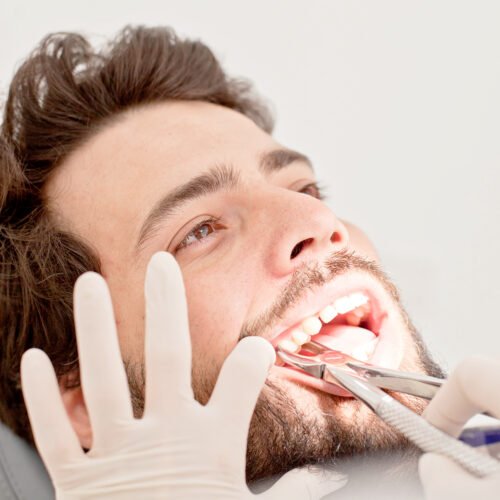 tooth removal